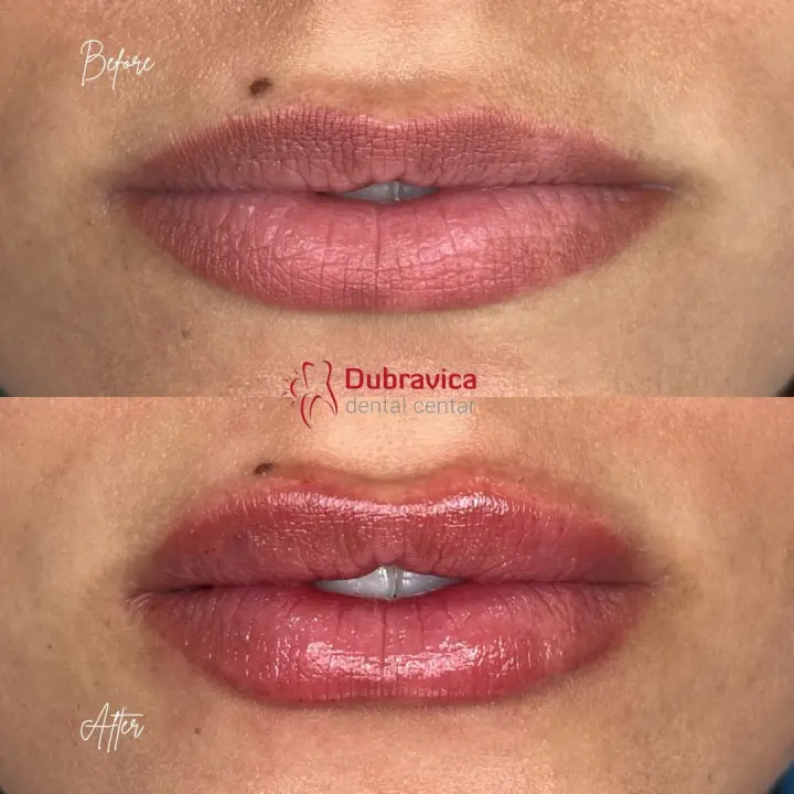 FOTO Dan žena u Dubravici: Iskoristite popust na najnovije trendove u estetskoj medicini 