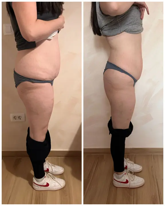 FOTO Beauty Clinic by Tamara: Smanjite celulit i ovo ljeto prošetajte plažom samouvjereno!