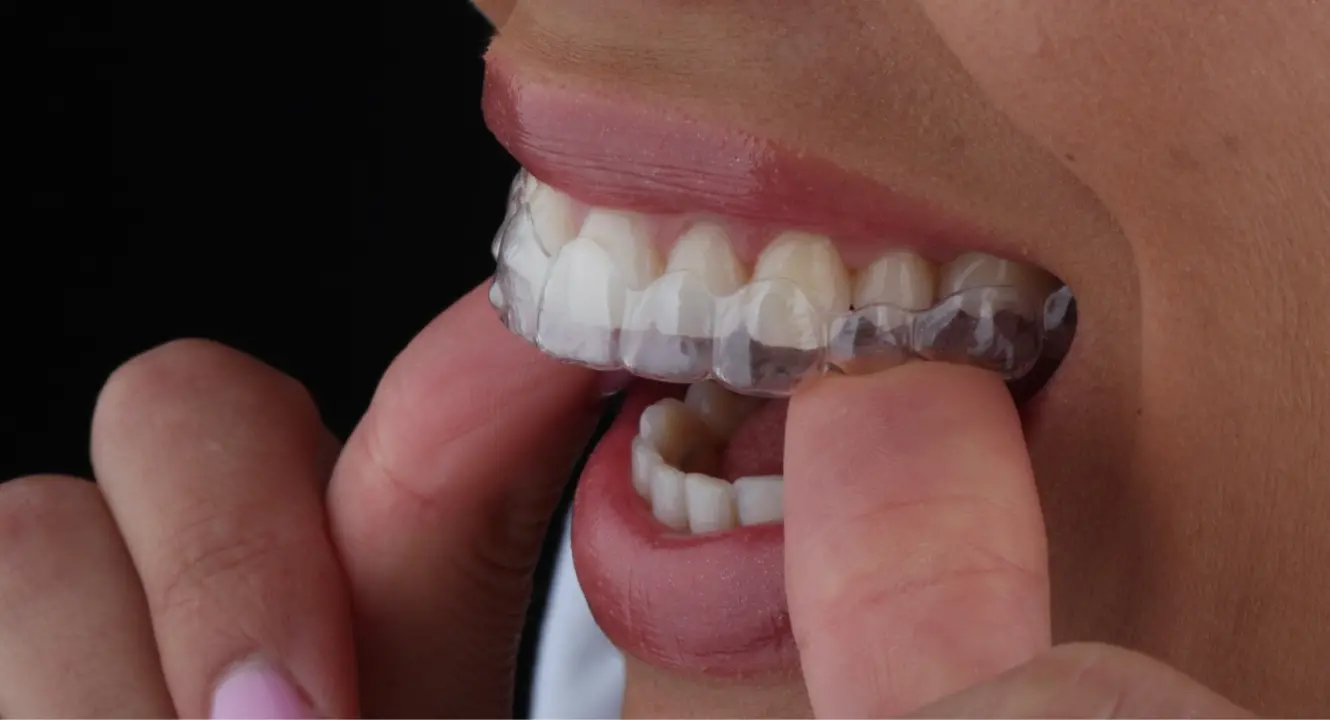 FOTO Transformirajte osmijeh prozirnim alignerima u Dental centru Dubravica! 	